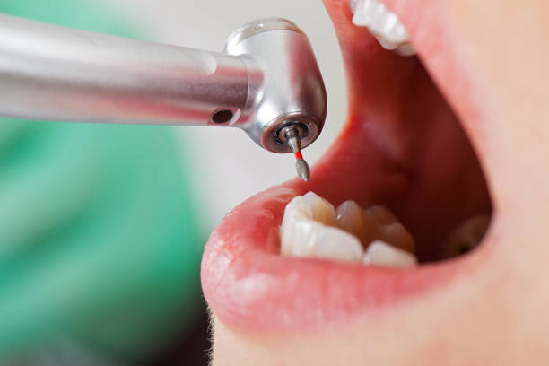 Best Emergency Dental Care for Broken or Chipped Teeth in Urbana, OH